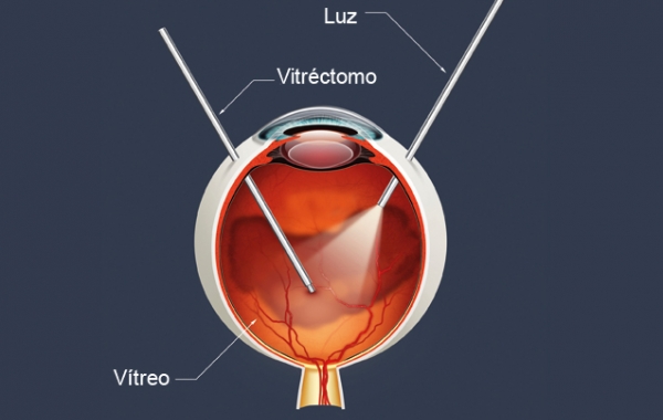 Vitrectomia (Retina e Vtreo)